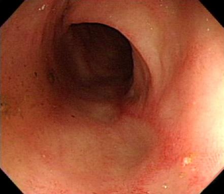 Endoscopic and pathologic findings of the stomach and duodenum. Diffuse erythematous and edematous mucosa was observed in the antrum (A) and duodenum (B).
