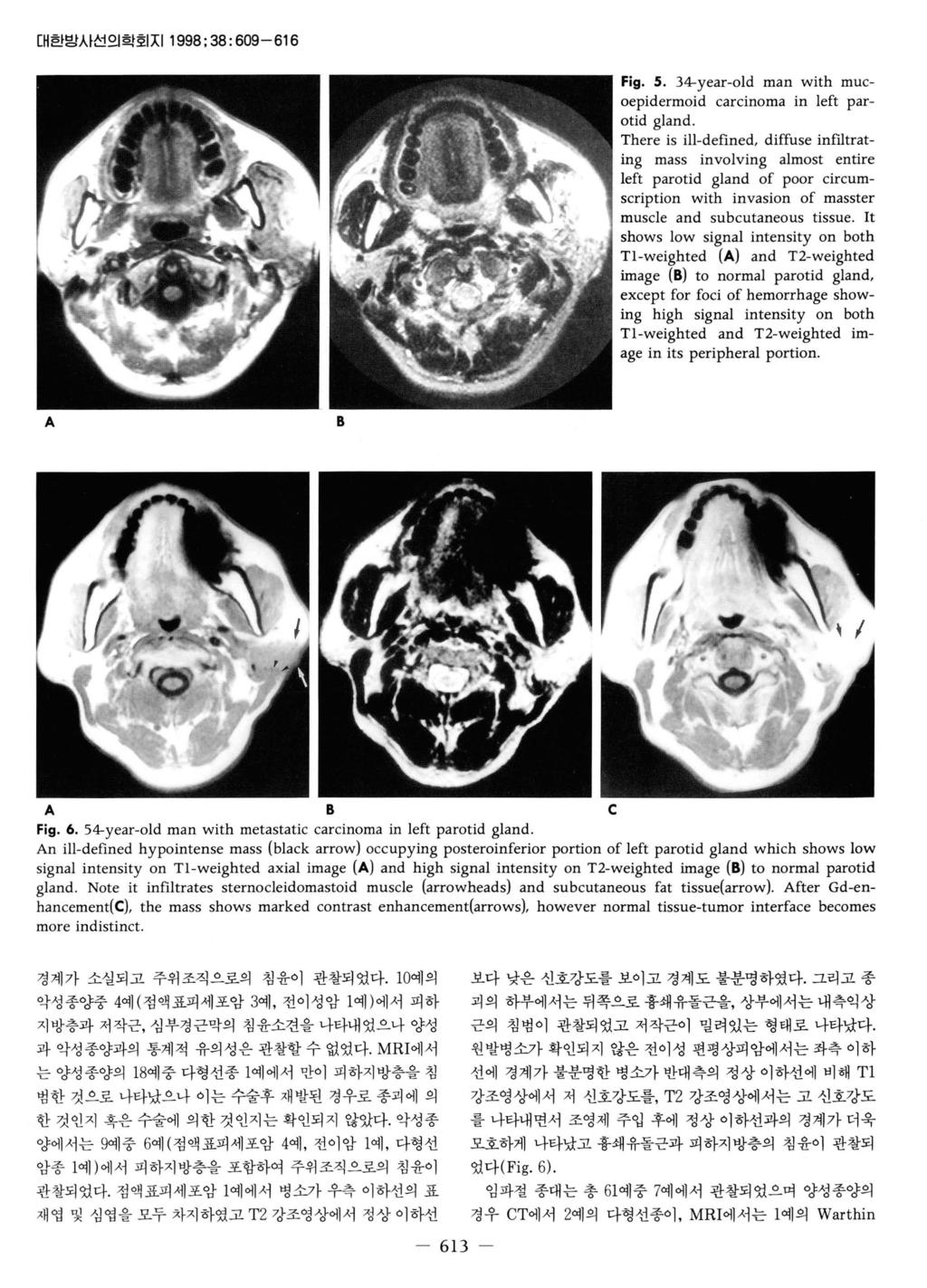 대한방사선의학회지 1998; 38: 609-616 Fig. 5. 34-year-old man with mucoepidermoid carcinoma in left parotid gland.