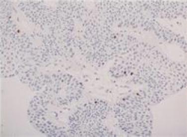 (F) Positive finding: Membranous expression of c-erb B2 protein was seen;