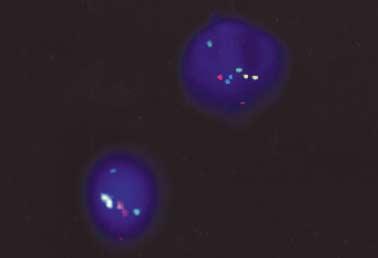방광암환자에서 FISH 의임상적유용성 201 A B Fig. 1. (A) Normal FISH result. Each probe signal (CEP3-red, CEP7-green, CEP17-aqua, and LSI 9p21-gold) is shown in two copies. (B) Aneusomic interphase cells.