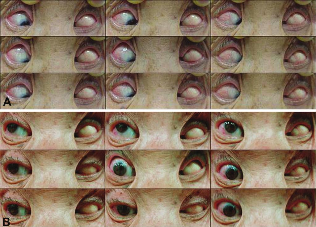 - 이준성 외 : 고도근시와 동반된 사시에서 수술 - Figure 1. (A) Preoperative photograph shows both eyes fixed in a position of extreme adduction and infraduction in 73-year-old female patient.