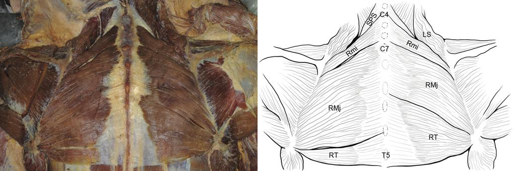 248 이지현, 정원석 Fig. 1. Photograph and drawing of the atypical rhomboid muscles. The rhomboideus minors arose from ligamentum nuchae of 4-6th cervical vertebrae level.