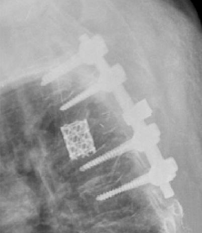 plates compressed spinal cord and it was found through various work-up that she had lung cancer