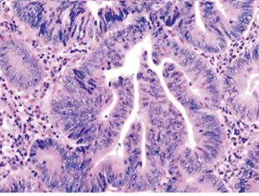 adenomatous component (carcinoma component가병변의 50% 이상 ) 에해당하는경우에만기록하며, 3 암종과분리된샘종은 separate lesion에기록한다. 샘종의 histology는 tubular (Fig.