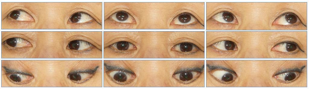 - 대한안과학회지 2018 년제 59 권제 4 호 - Figure 3. Images of the patient in nine diagnostic position of gaze at 3 months after the treatment. The patient showed stable ocular alignment without diplopia. 인은아니다.