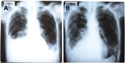 Table 1. Laboratory Findings Data Before (2013.3.16) After (2013.3.25) Data AST (0~31 U/l) ALT (0~34 U/l) γ-gtp (7~32 U/l) Creatinine (0.66~1.09 mg/dl) BUN (0.66~1.09 mg/dl) LDH (7.