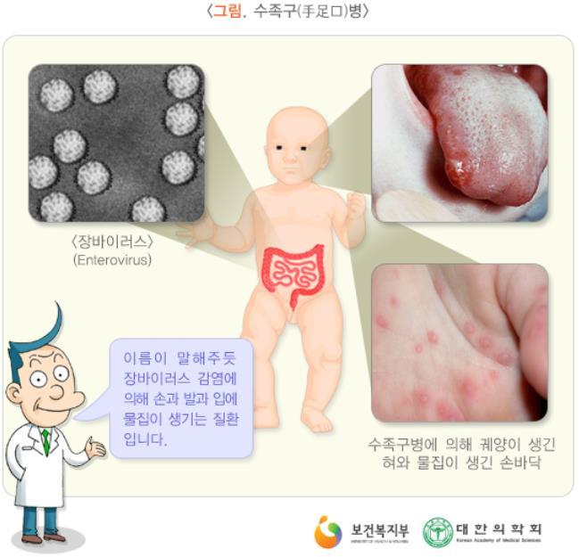 Special Issue 수족구병 (Hand-foot-and-mouth disease) 1.