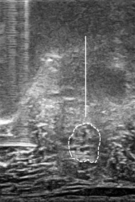 (A) Gross photograph shows ultrasound probe and spinal needle position for the right femoral nerve block with the patient positioned supine.