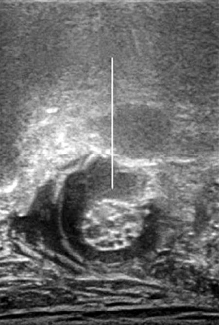 (C) Ultrasound image shows the anesthetic and spinal needle around the right femoral nerve during injection. Figure 2.