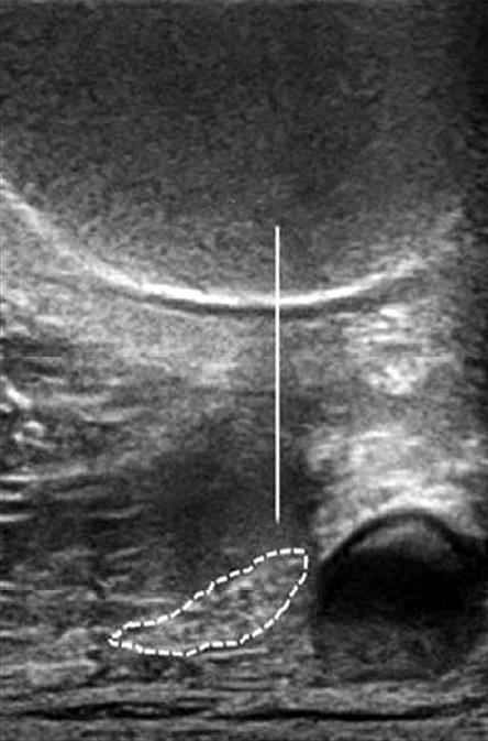 (B) Ultrasound image shows sciatic nerve and spinal needle more proximally than the popliteal crease level (level of Fig. 2A image).