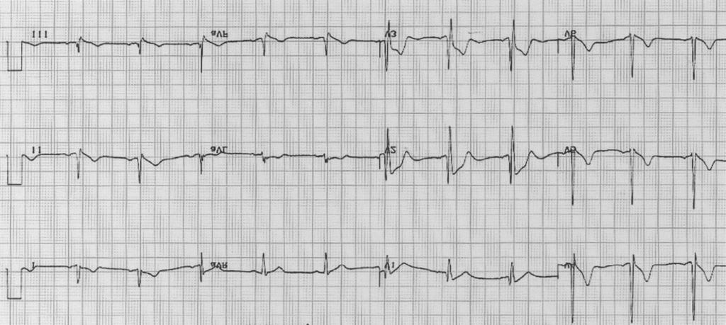 Fig. 1. The 12-lead electrocardiogram of the proband shows J point elevation and incomplete right bundle branch block in V1-3. 과거력 및 가족력 실신 및 돌연사 등의 특이한 병 력은 없었다.