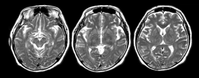 (A) Brain MRI T1-weighted images show