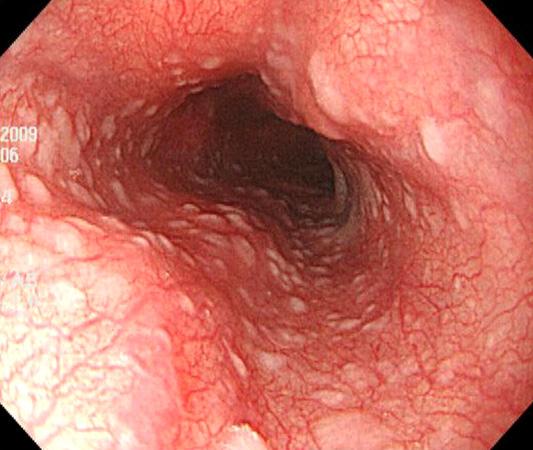 (B) Multiple variable-sized round polipoid lesions were noted in the whole stomach.