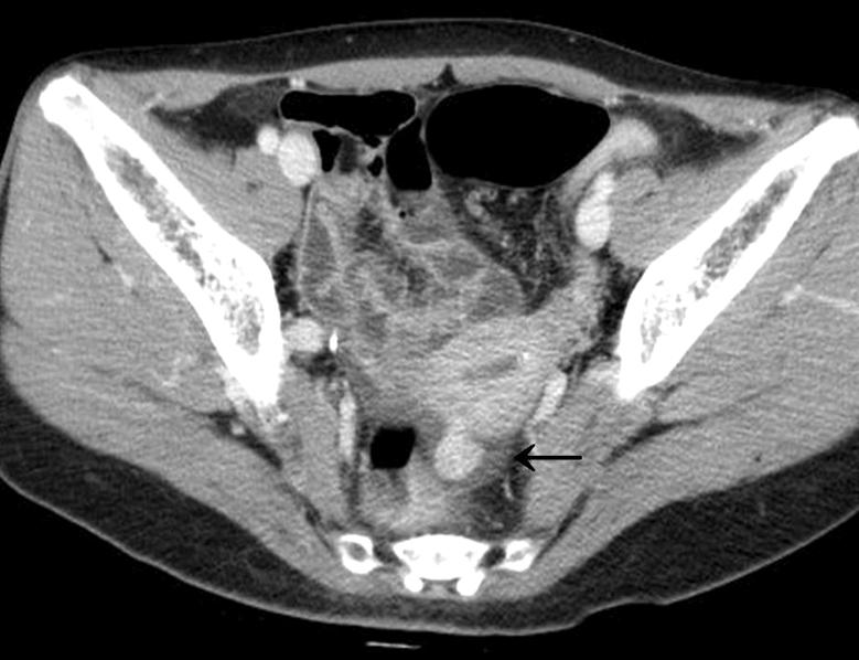 건강검진 내시경에서 위용종증이 발견되어 진단된 코우덴병의 1예 이지은 외 Figure 4. Abdominopelvic CT scan (A) There were multiple small sized (less than 1.