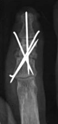 (A) The anteroposterior view of the preoperative X-ray
