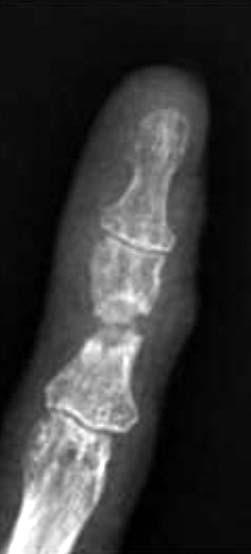 fracture of left index finger.
