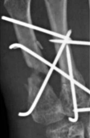 Multiple fractures were fixed mulitple K-wires at the