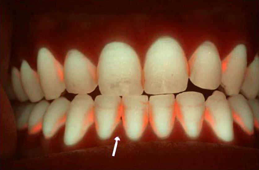 또한 QLF 시스템을활용하면실란트대상치아선정시, 치아의건전한상태를정확히파악할수있다.