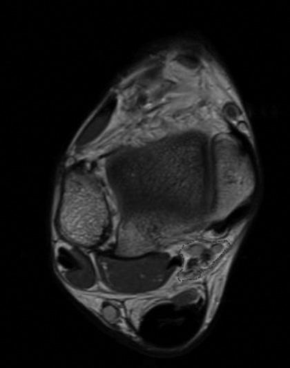 족근관의횡단면적측정을통한특발성족근관증후군의진단에있어 MRI 의가치 A B C Fig. 1. The three axial levels of the tarsal tunnel at which the cross-sectional area were measured. A. Cross section of ankle at level of tibiotalar joint.
