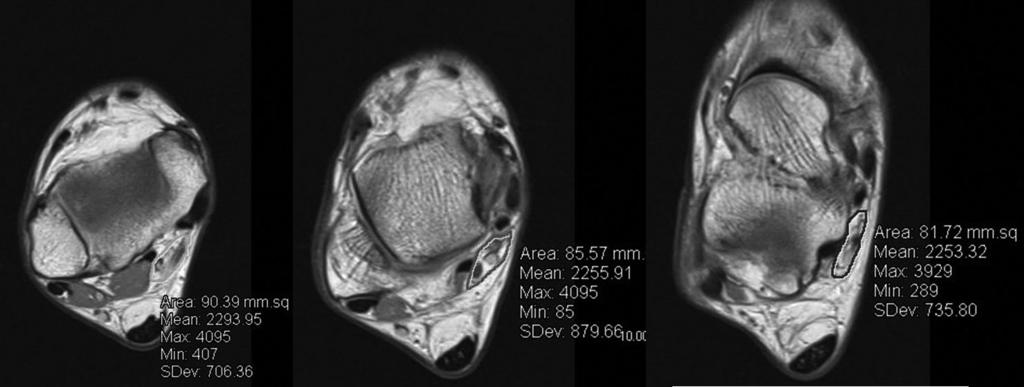 김민정외 Fig. 2. MR axial image of 59/M with idiopathic tarsal tunnel syndrome, right ankle. Some of the patient group showed flattened appearance of fibro-osseous tunnel on the transverse images. Fig. 3.
