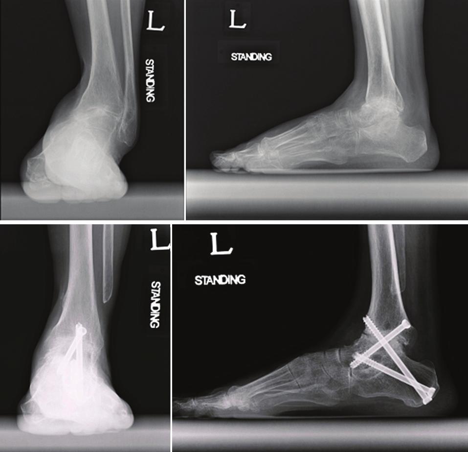 A B Figure 2. (A) Preoperative radiographs of the 57 year-old female showed ankle and subtalar osteoarthritis with severe varus.