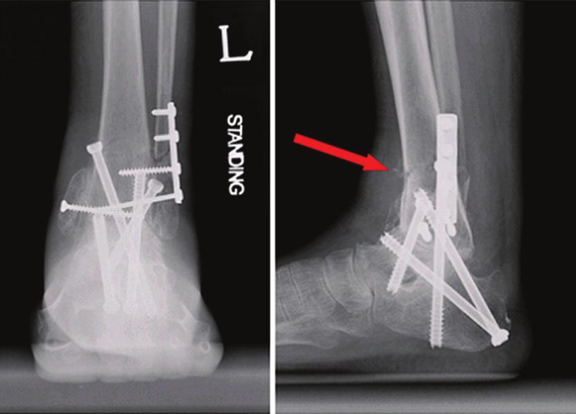 정홍근 박신형 유현열 유문집 Figure 3. Sixty-two year old female with Charcot joint arthropathy developed distal tibia stress fracture 6 months after TTC joint fusion.