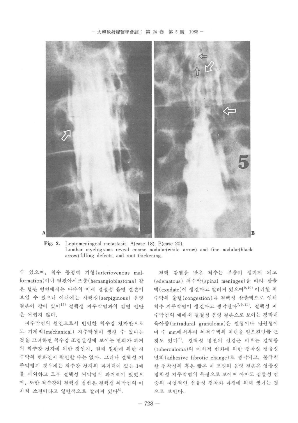 大韓放射線훌훌學會誌 : 第 24 卷第 5 號 1988 - Fig. 2. L eptomeningeal metastasis.