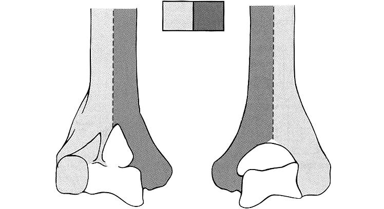 대한골절학회지제25권, 제3호, 2012년 7월 Journal of the Korean Fracture Society Vol. 25, No.