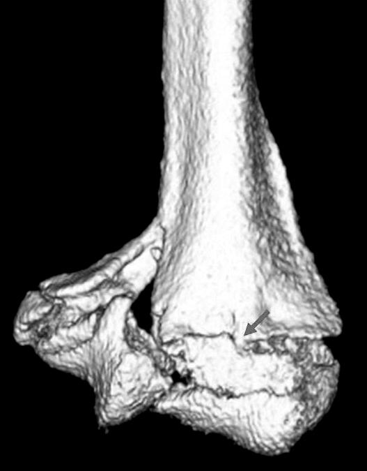 226 윤용철, 오종건 Fig. 6. A 3D computed tomography which displays a coronal bone fragment invading the front of trochlea (arrow).