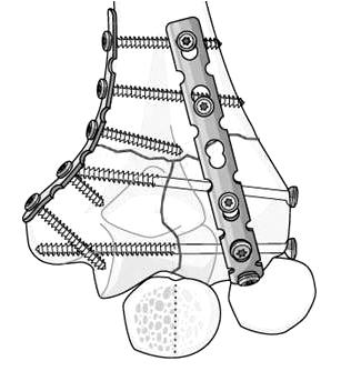 O Driscoll 은 right angle plating 의이러한단점을지적하면서이를극복할수있는대안으로다음절에서기술할 parallel plating 개념을도입하였고이는상완골원위부관절내골절치료의결과를향상시키는데크게기여를하였다 19,20).