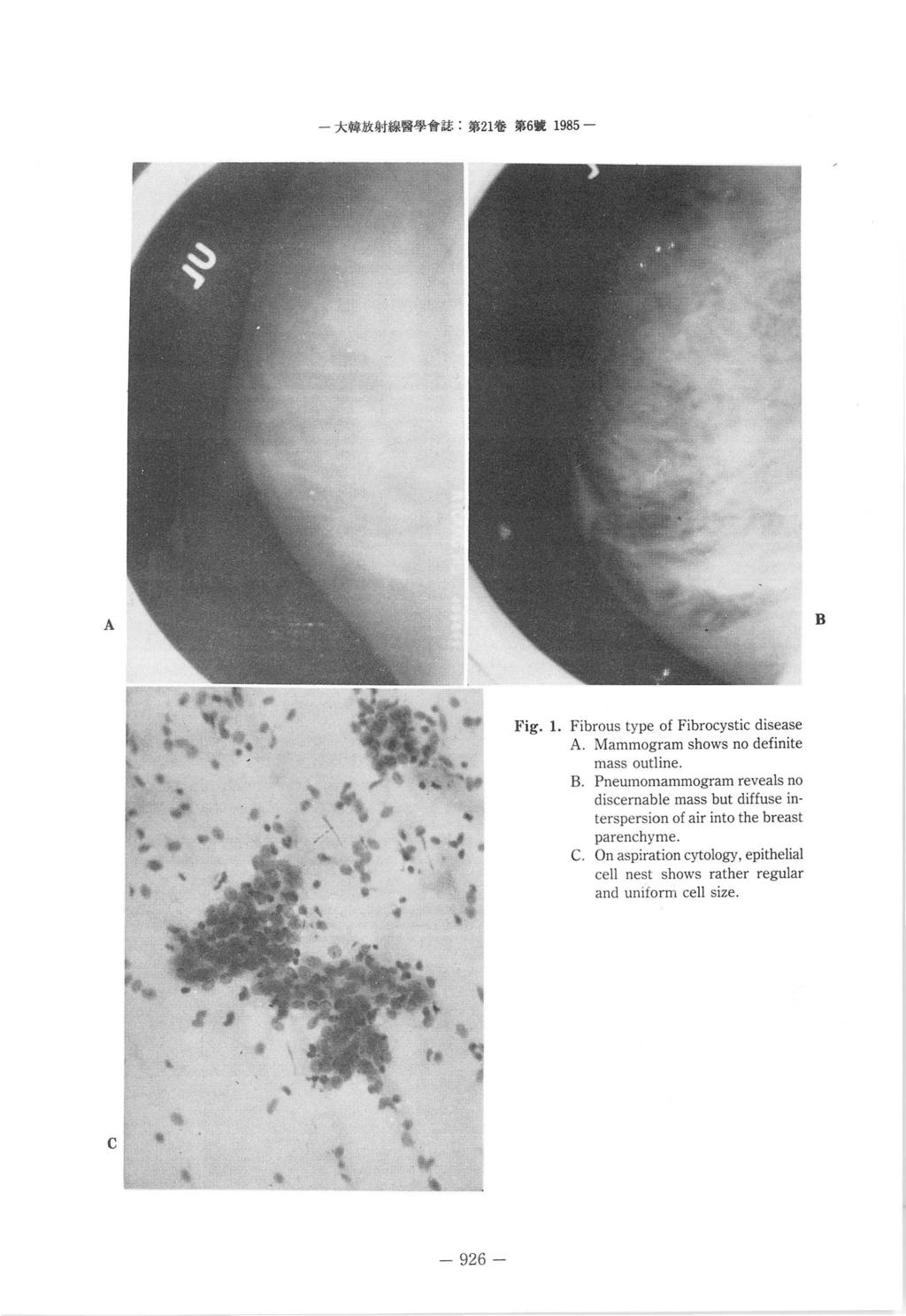 r - 大韓放射線뽑學會誌 : 第 1 옳第 6 훌 1985- A B.Fig. 1. Fibrous type of Fibrocystic disease A. Mammogram shows no definite mass outline B.
