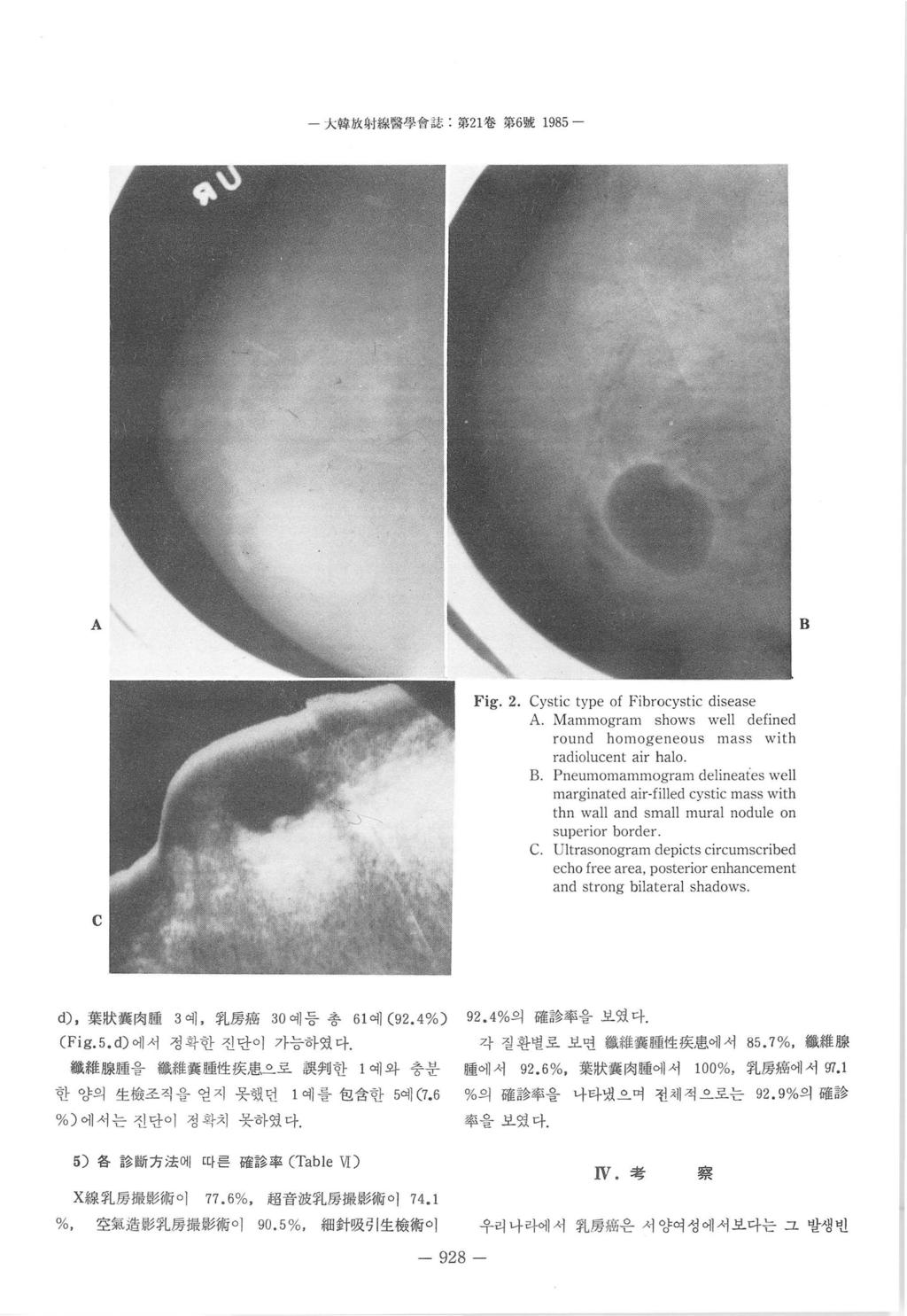 太웹 JíX M Mtl 양용짱 1'1- 쉽第 1 卷第 6 跳 1985 - A B Fig.. Cystic type of Fibrocystic disease A. Mammogram shows well defined round homoge neous mass with radiolucent air halo B.