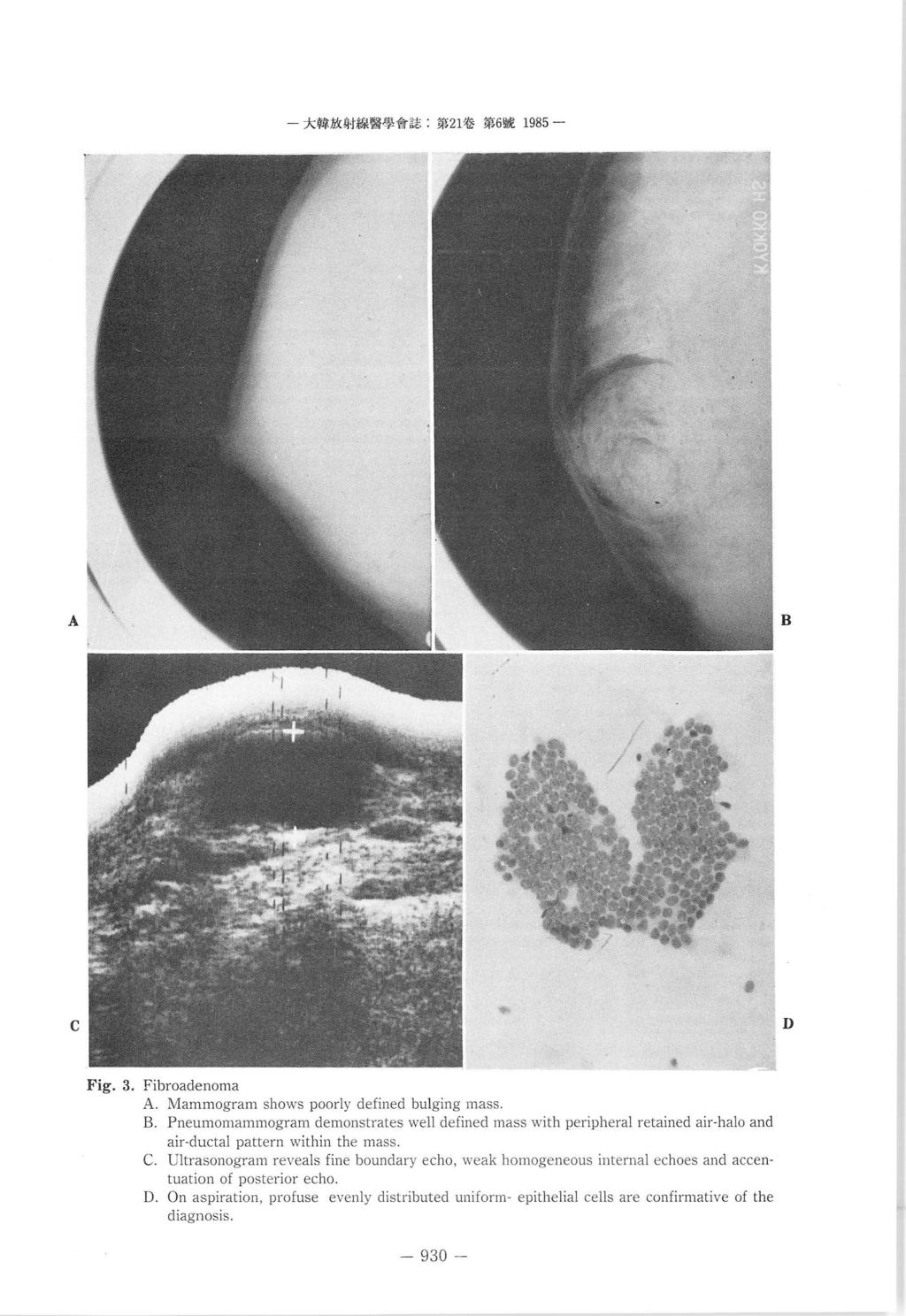 - 大韓 X 4 t 線醫學會註 : 第 1 卷第 6 號 1985 - A B C D Fig.. Fibroadenoma A. Mammogram shows poorly defined bulging mass B.