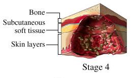 Wound Stage of Classification Stage 1 Stage 2 Stage 3 Stage 4 DTI Unstageable stage1