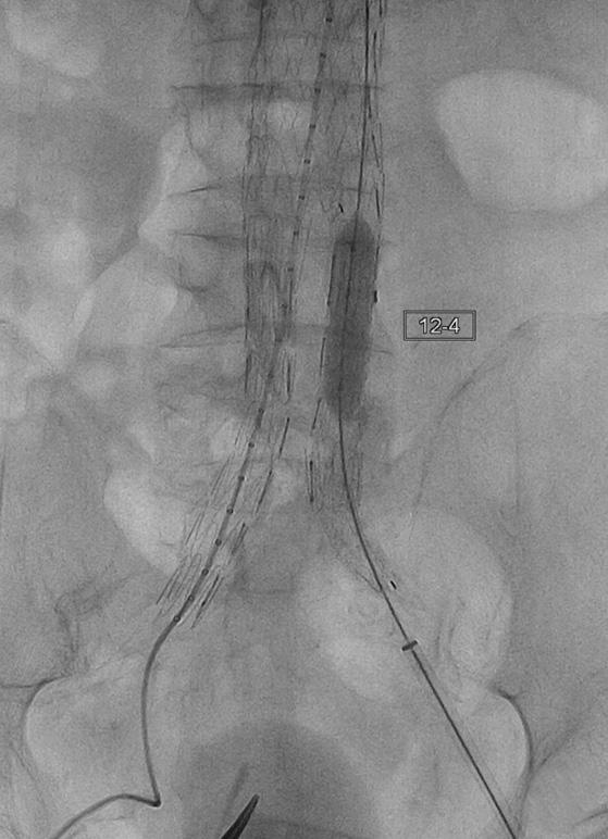 144 Korean J Vasc Endovasc Surg Vol. 29, No. 4, 2013 Fig. 3. Angiographic images of (A) type Ib endoleak (arrow) and (B) 12 mm molding balloon. Fig. 4. Completion angiography shows patent bilateral iliac flow without residual endoleak.