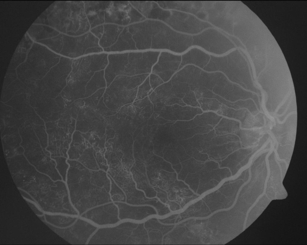 () Retinal vessels are orange-colored and arterioles and