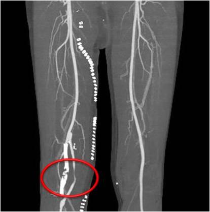 - 대한내과학회지 : 제 83 권제 6 호통권제 628 호 2012 - A B Figure 3. (A) Lower extremity CT shows stent fracture.
