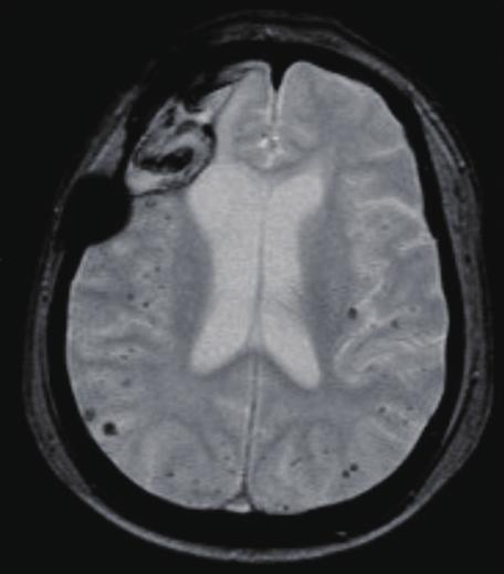 정상인의 CAA 의 소동맥에서 발견되는 아밀로이드는 AD의 노인판(amyloid plaque)에서 주로 발견되는 4개의 아미노산을 가진 Aβ4가 아니 고, 4개의 아미노산을 가진 Aβ4이다. CAA에서 아밀로이드가 침 착되는 원인은 Aβ4의 생산이 증가되거나 제거 기능이 저하되기 Fig. 4. MRI and histopathologic features of the 7-year-old female with dementia and recurrent lobar hemorrhages.