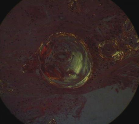 On gradient echo MRI, there are numerous microbleedings mostly on the cortex (B). Thickened homogeneous pink material is noted in the H&E stain (C).