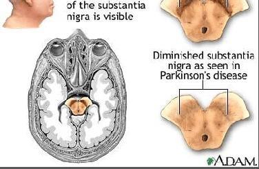 1. 파킨슨씨병 (PARKINSON S DISEASE) 정의 원인 운동조절을맡고있는뇌중추침범 > 기저신경절의퇴행, 진행성신경질환