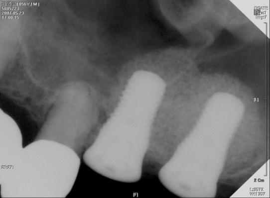 Implant Placement on Severe