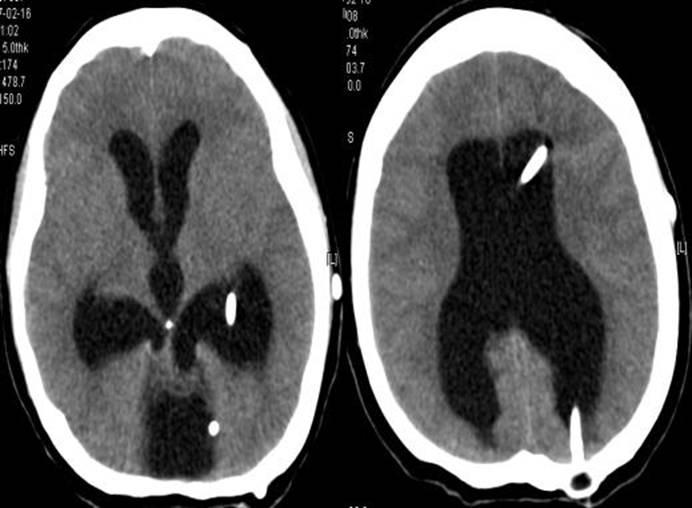 Brain CT was performed at admission.