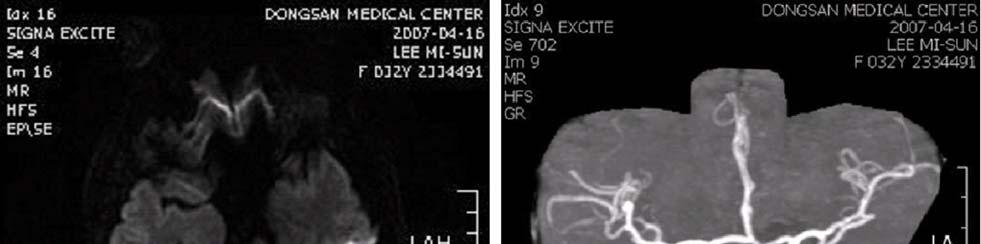 대한생식의학회지 Figure 1. MRI reveals acute infarcted lesion at the left pontine and left cerebellar hemisphere due to occlusion of mid basilar artery. 현병력 : 첫아이질식분만후 3년간의이차성불임으로 2006년불임검사위해본원에내원하였다.