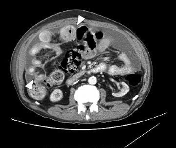 -Il Young Kim, et al : Encapsulating peritoneal sclerosis presenting with a fulminant clinical course - A B Figure 2.