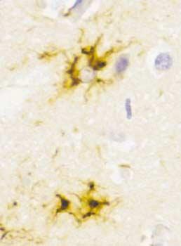 Note the shrunken substantia nigra pars compacta (SNc), subthalamic nucleus (STN), and the internal segment of the globus pallidus (GPi), consistent with a marked loss of neurons.