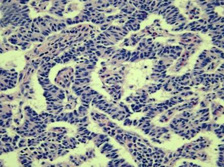 Figure 4. Pathologic findings. (A) Tumor cells confined to the submucosa, with tumor-free margins (arrow). There is no involvement of muscularis propria (H&E stain, 40).