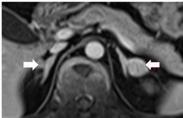 - Min Jung Bae, et al. A case of carney complex with multiple spinal fractures - A B Figure 3. MR analyses.