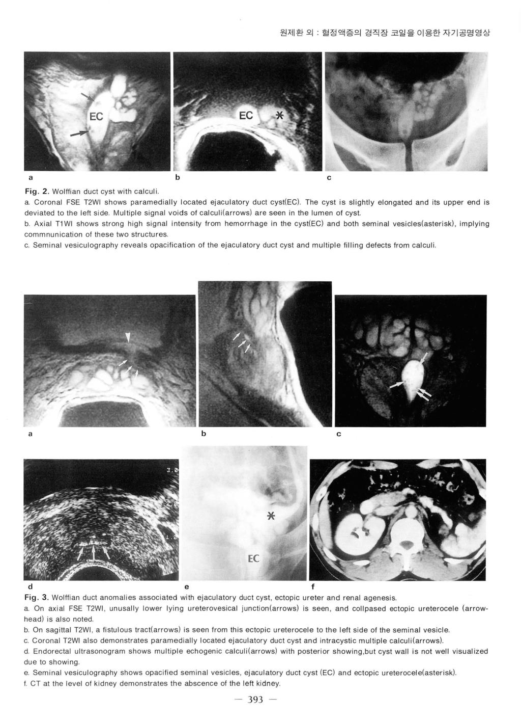 원제환오 힐정액증의경직장코일을이용한자기공명영상 a b c Fig. 2. Wolffian duct cyst with calculi a. Coronal FSE T2WI shows paramedially located ejaculatory duct cyst(ec).