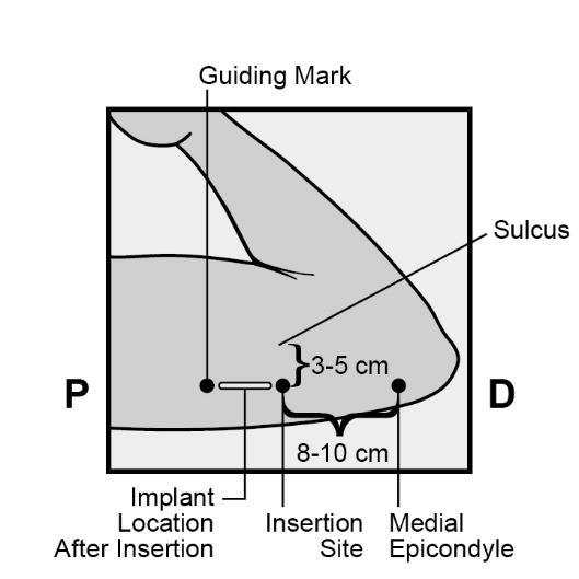 위치하도록한다 (Figure 1). Figure 1 - 잘사용하지않는팔의상완안쪽으로삽입위치를확인한다. 삽입부위는위팔뼈 ( 상완골 ) 의안쪽위관절융기 (medial epicondyle) 로부터약 8-10 cm (3-4 인치 ) 지점이자이두근과삼두근사이의고랑 (sulcus, 홈 ) 뒤 3-5 cm (1.
