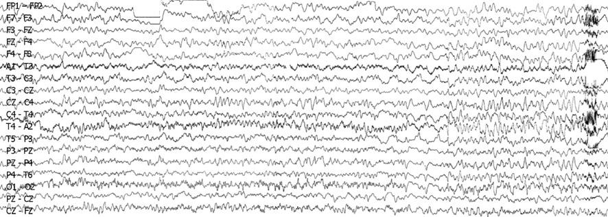 역행성기억장애를주로보인바이러스성뇌염 1 예 Figure 2. EEG recorded during status epilepticus on the 6th hospital day.